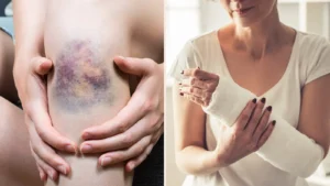 Signs of a Vitamin K Deficiency